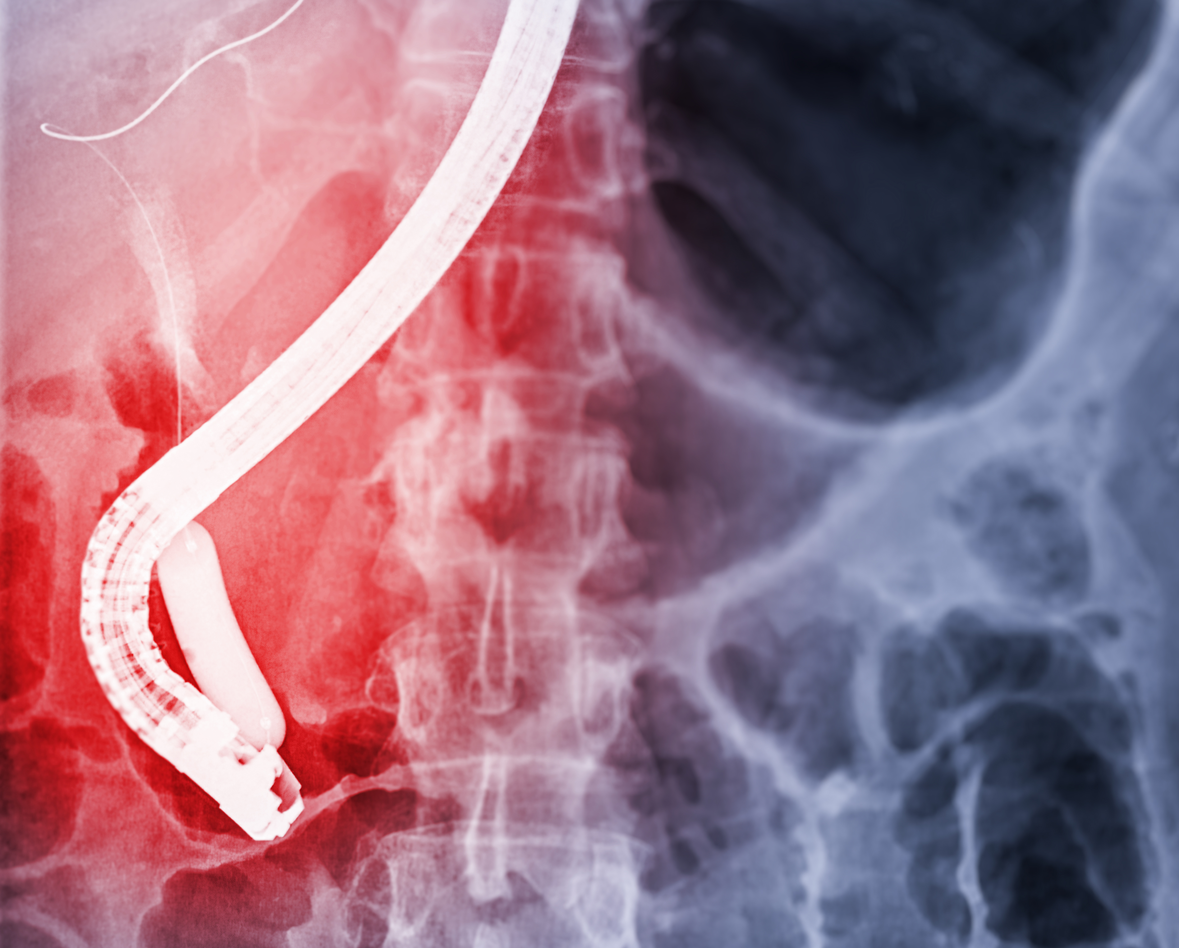 千庫網(wǎng)_醫(yī)生在現(xiàn)代手術(shù)室內(nèi)進行 ERCP 和腹腔鏡膽囊切除術(shù)后內(nèi)窺鏡的 X 射線圖像。_攝影圖編號15053027_愛奇藝.jpg